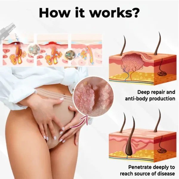 Fivfivgo® Female HPV Genital Wart Caring Spray