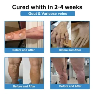 Fivfivgo® Nano-Microneedle Joint Patch