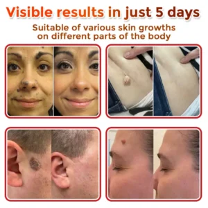 Fivfivgo® MicroNeedle Botanic Skin Tag Removal Patch 🇺🇸 Made in the USA