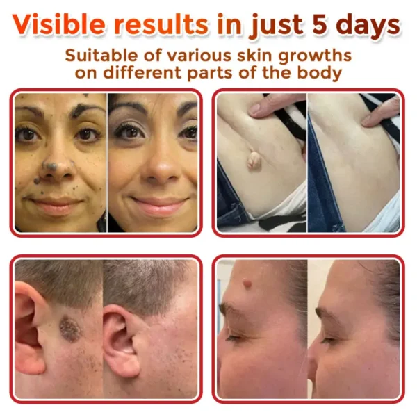 Fivfivgo® MicroNeedle Botanic Skin Tag Removal Patch 🇺🇸 Made in the USA