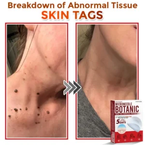 Fivfivgo® MicroNeedle Botanic Skin Tag Removal Patch 🇺🇸 Made in the USA