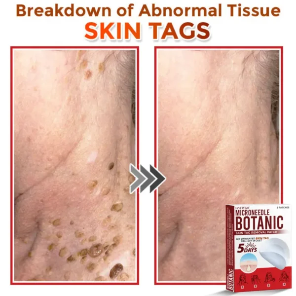 Fivfivgo® MicroNeedle Botanic Skin Tag Removal Patch 🇺🇸 Made in the USA