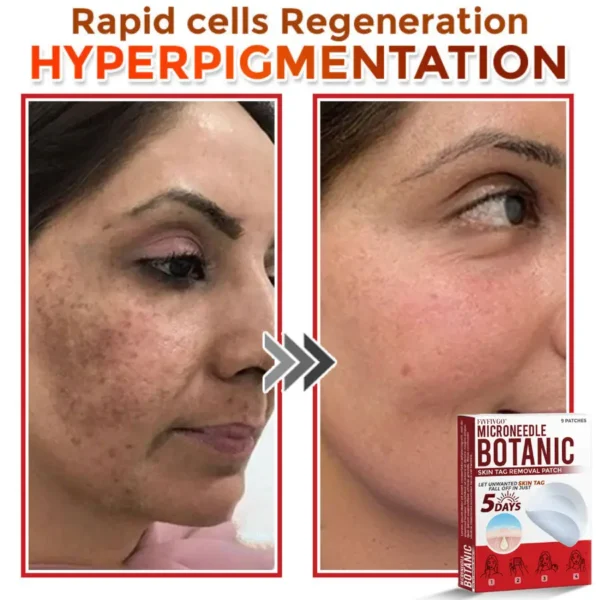 Fivfivgo® MicroNeedle Botanic Skin Tag Removal Patch 🇺🇸 Made in the USA