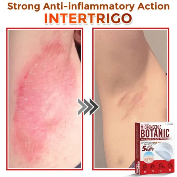 Fivfivgo® MicroNeedle Botanic Skin Tag Removal Patch 🇺🇸 Made in the USA
