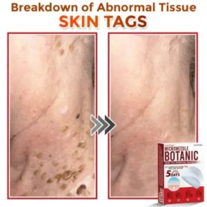 Fivfivgo® MicroNeedle Botanic Skin Tag Removal Patch