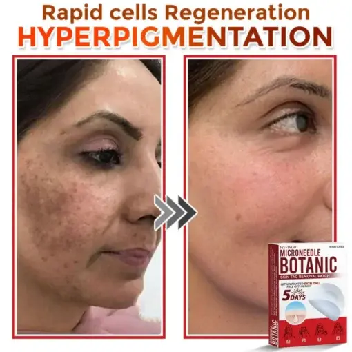 Fivfivgo® MicroNeedle Botanic Skin Tag Removal Patch