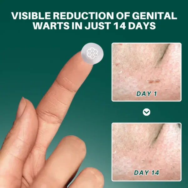 Fivfivgo® Magnesium MicroPin HPV Genital Wart Removal Patch - Image 3
