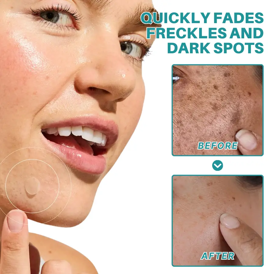 Fivfivgo® Botanical Freckles & Spot Removal Patch