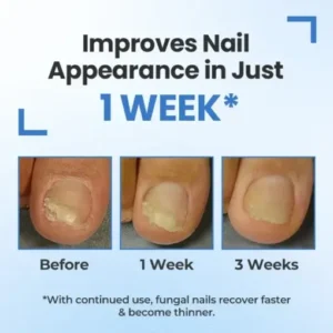 Fivfivgo® MycoErase Nail Revive Pen