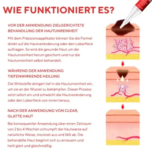 Fivfivgo® Stift zum Entfernen von Hautflecken und Leberflecken