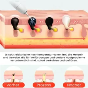 Fivfivgo™ Tragbarer Hautpflege-Laserstift