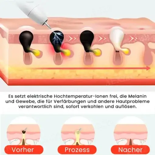 Fivfivgo™ Tragbarer Hautpflege-Laserstift