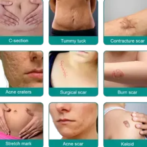 Fivfivgo™ Advanced Scar Removal Spray