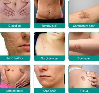 Fivfivgo™ Advanced Scar Removal Spray